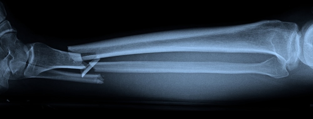 Fixation Methods in Limb Lengthening: Internal vs. External